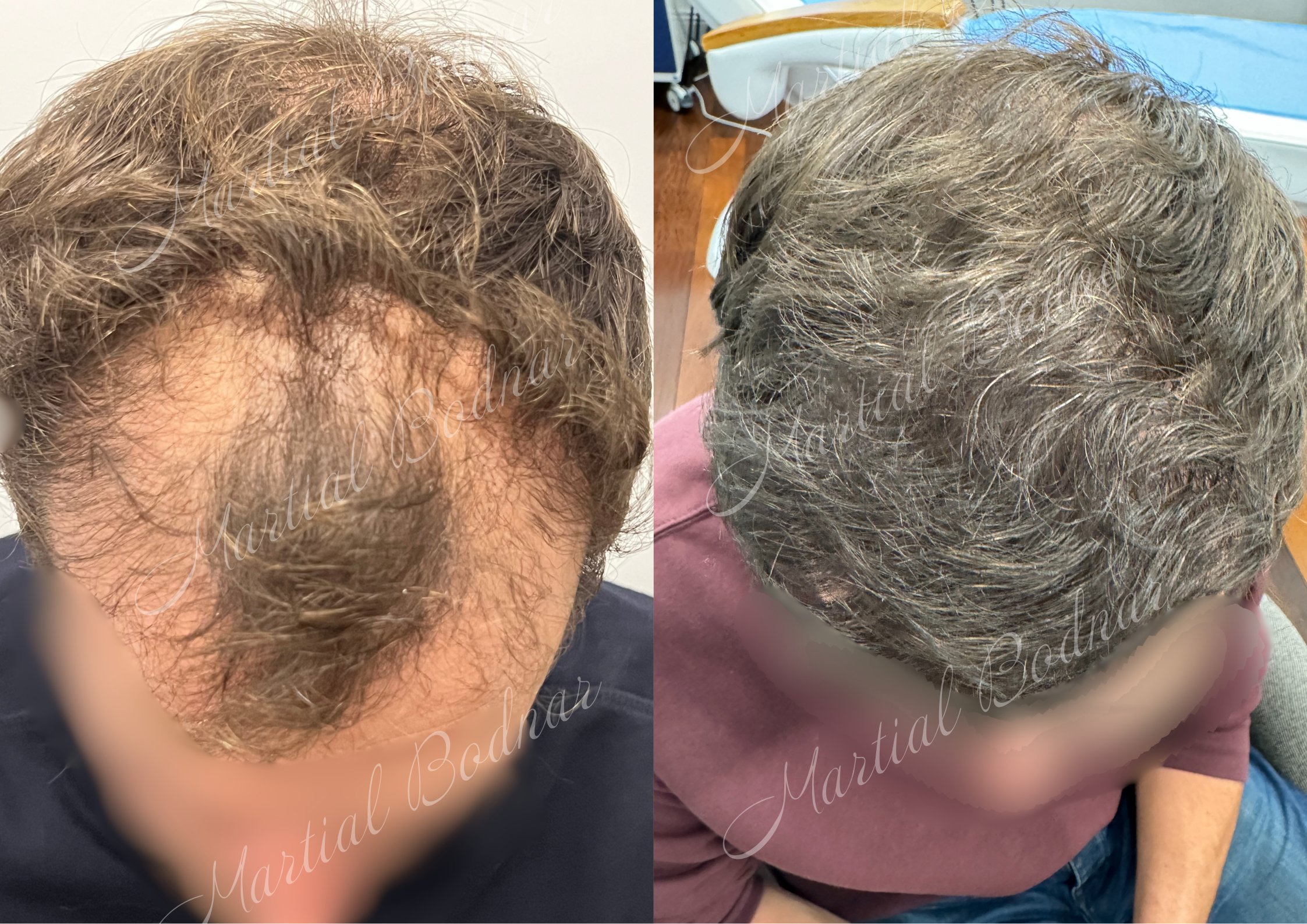 greffe de cheveux avant après réalisée par le docteur martial bodnar