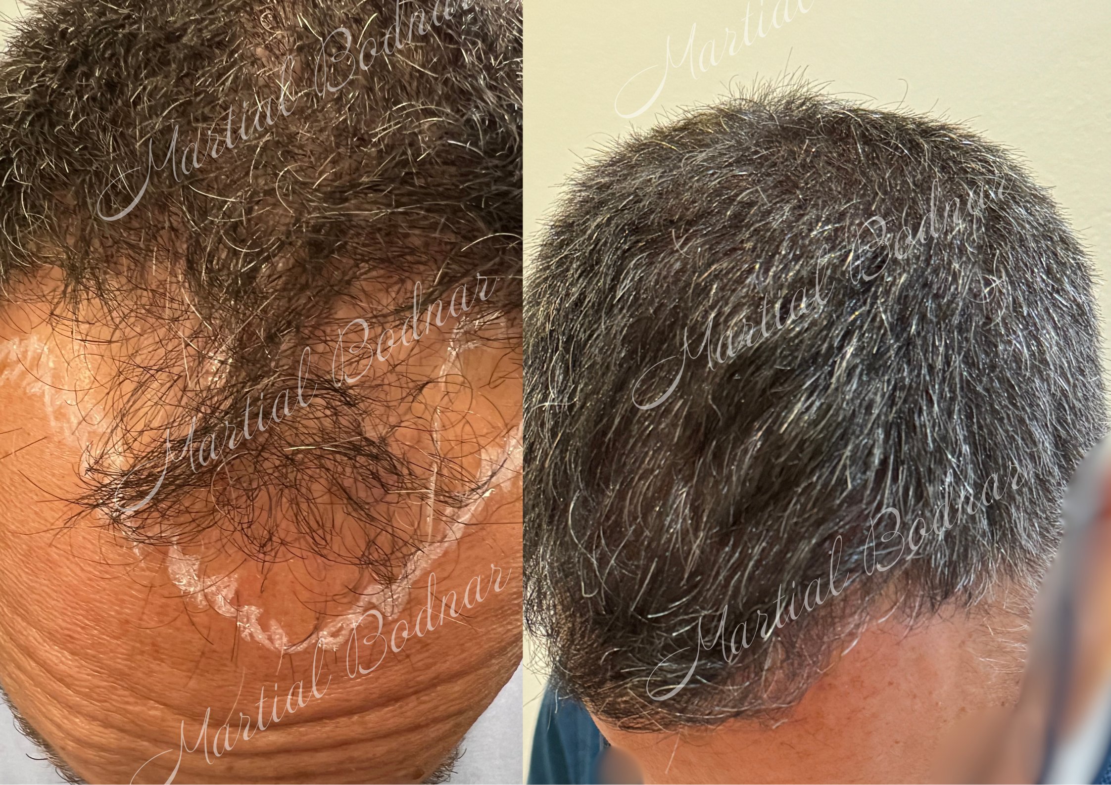 greffe de cheveux avant après réalisée par le docteur martial bodnar