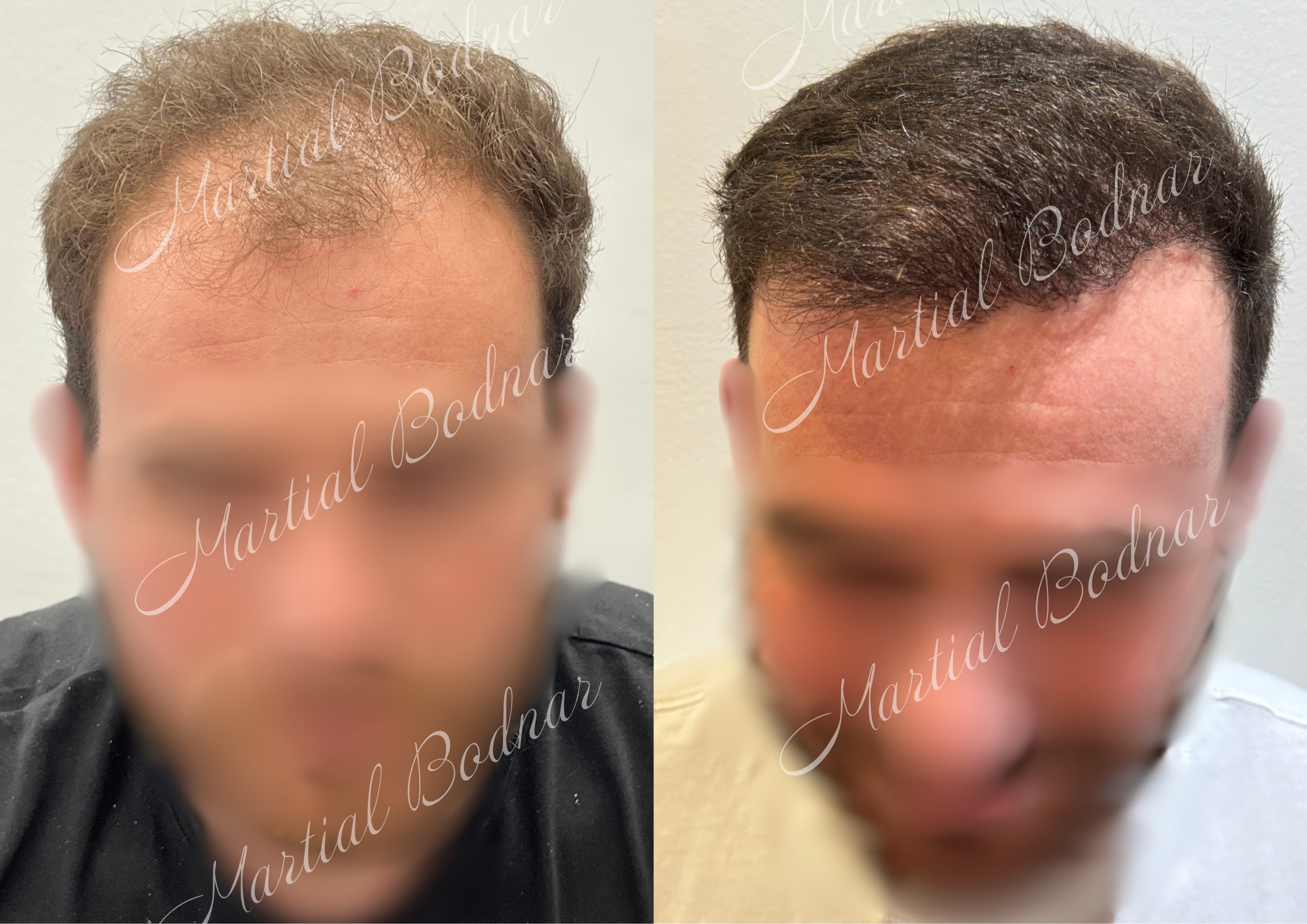 greffe de cheveux avant après réalisée par le docteur martial bodnar