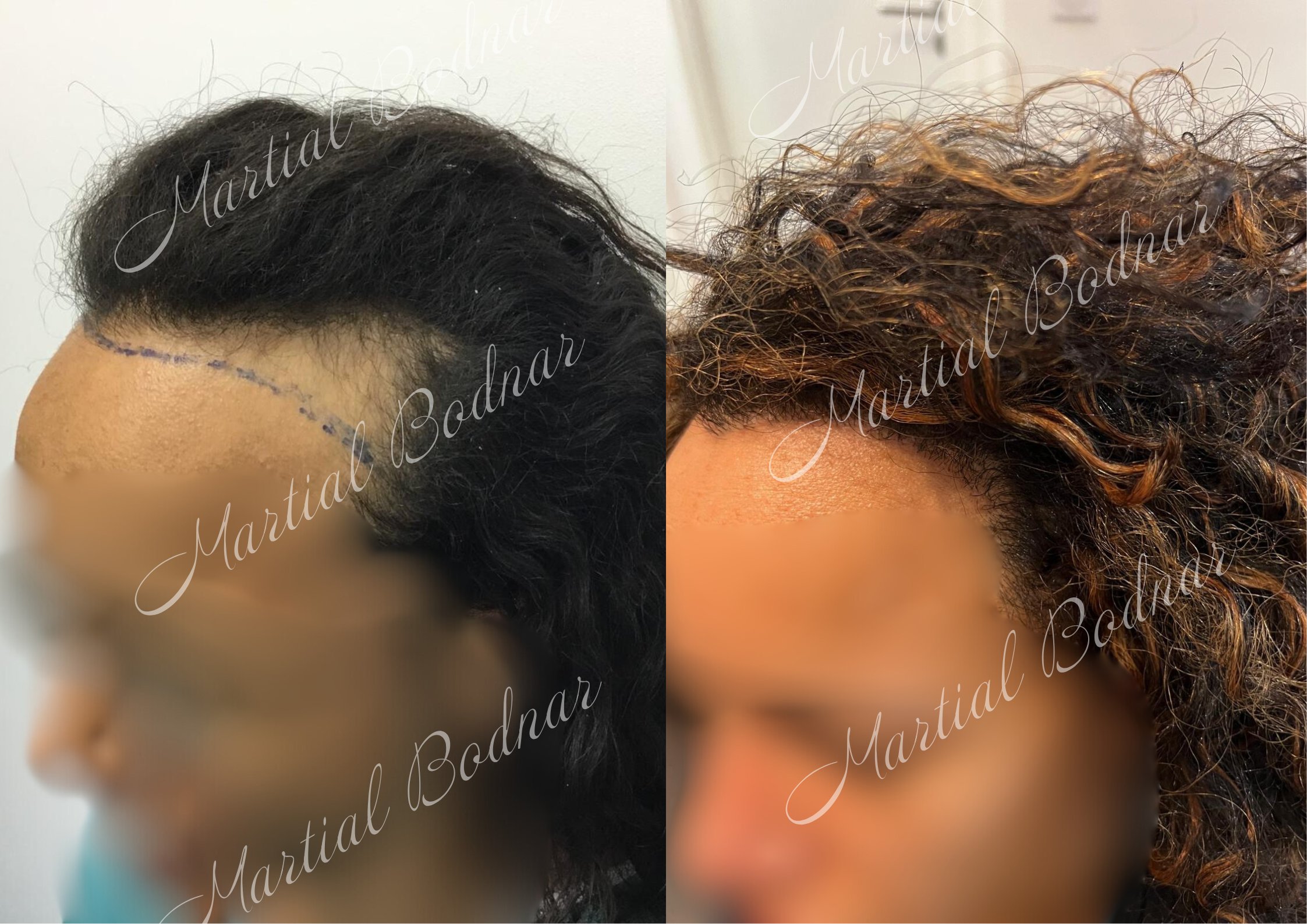 greffe de cheveux avant après réalisée par le docteur martial bodnar