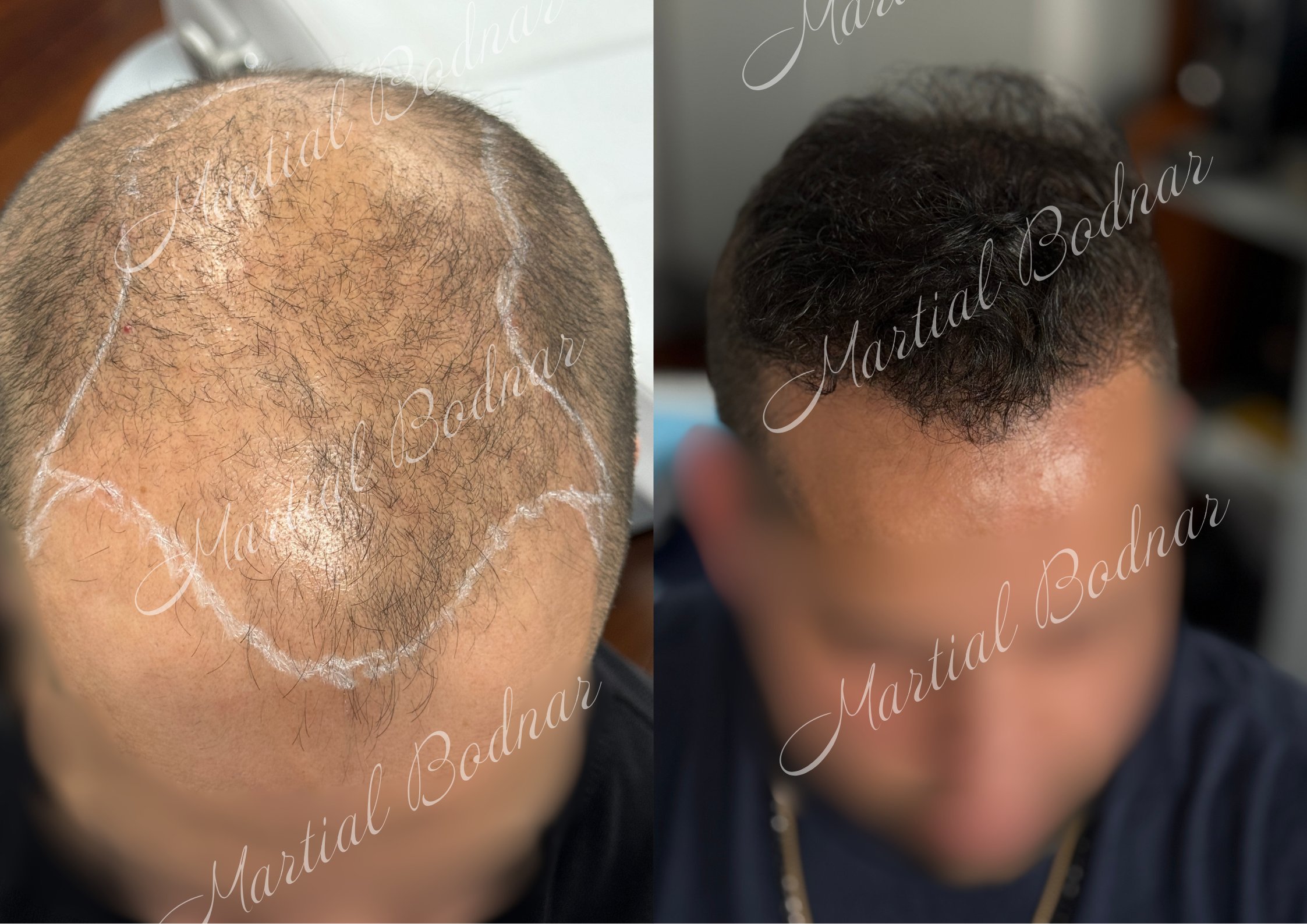 greffe de cheveux avant après réalisée par le docteur martial bodnar