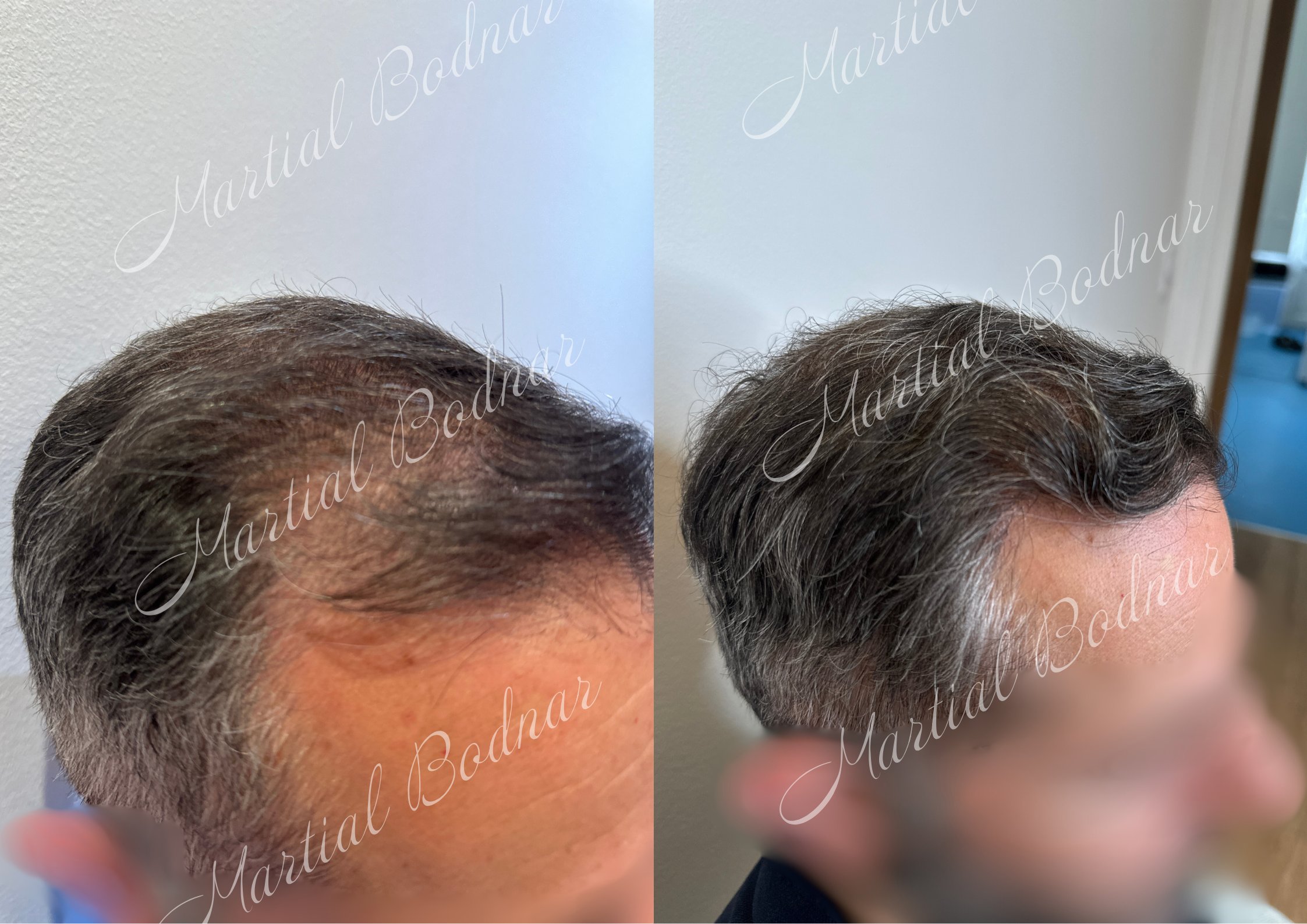 greffe de cheveux avant après réalisée par le docteur martial bodnar