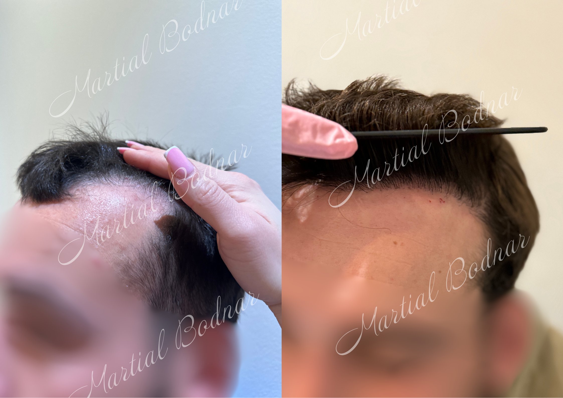 greffe de cheveux avant après réalisée par le docteur martial bodnar