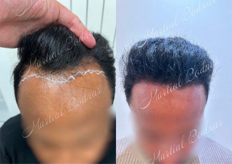 patient avant et après une intervention de greffe de cheveux au cabinet du docteur bodnar