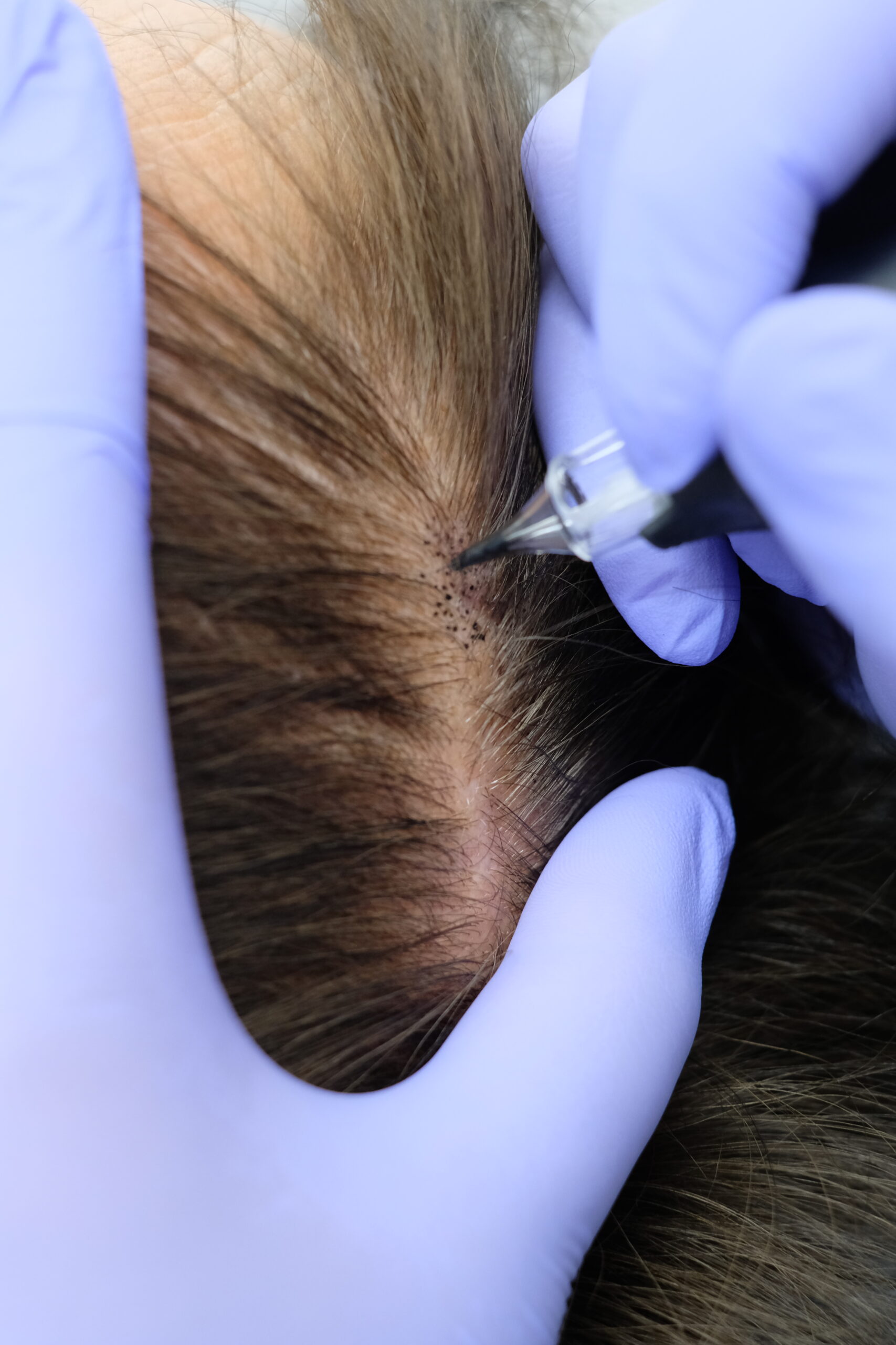 séance de tricopigmentation au cabinet du docteur bodnar à toulouse