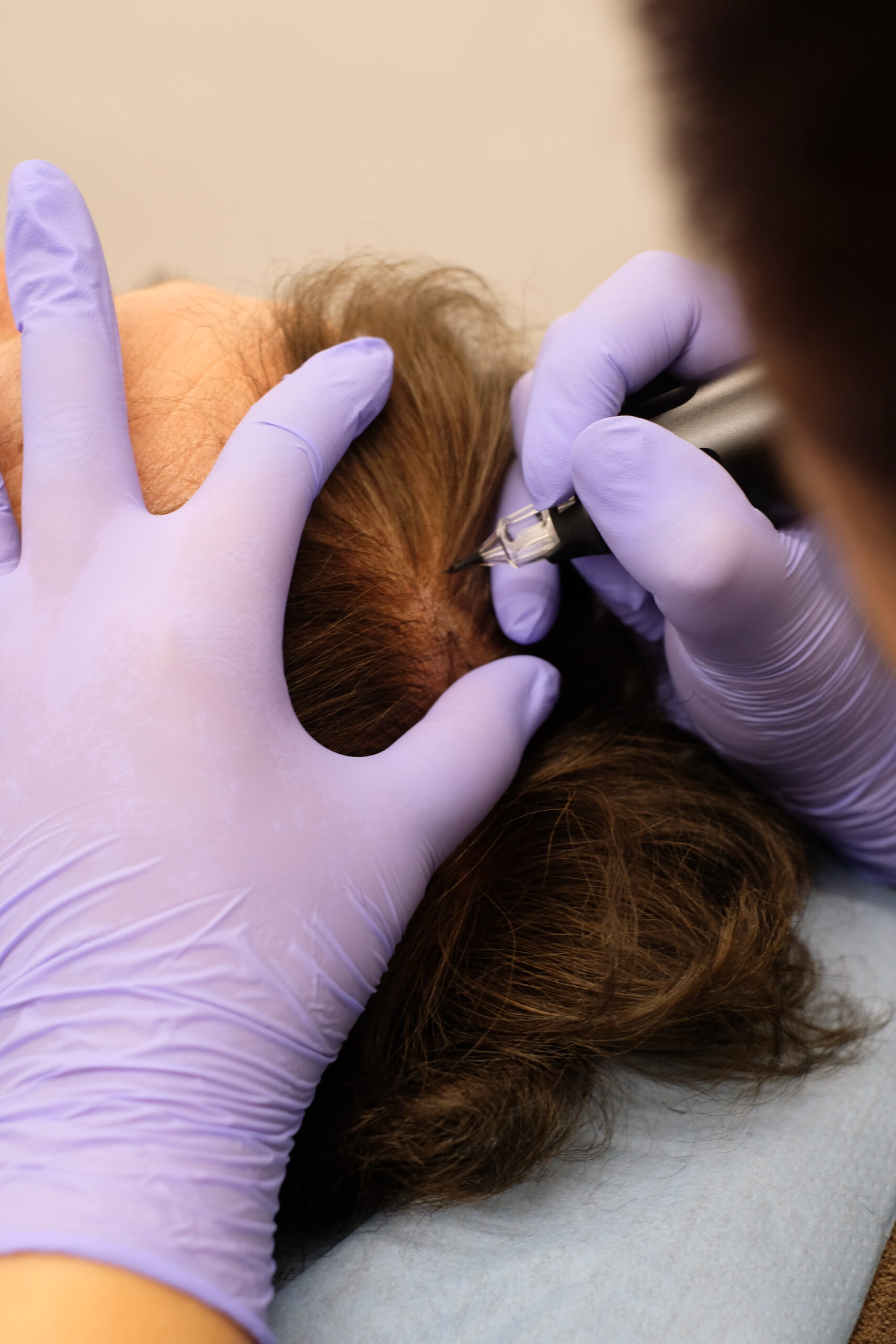 intervention de tricopigmentation