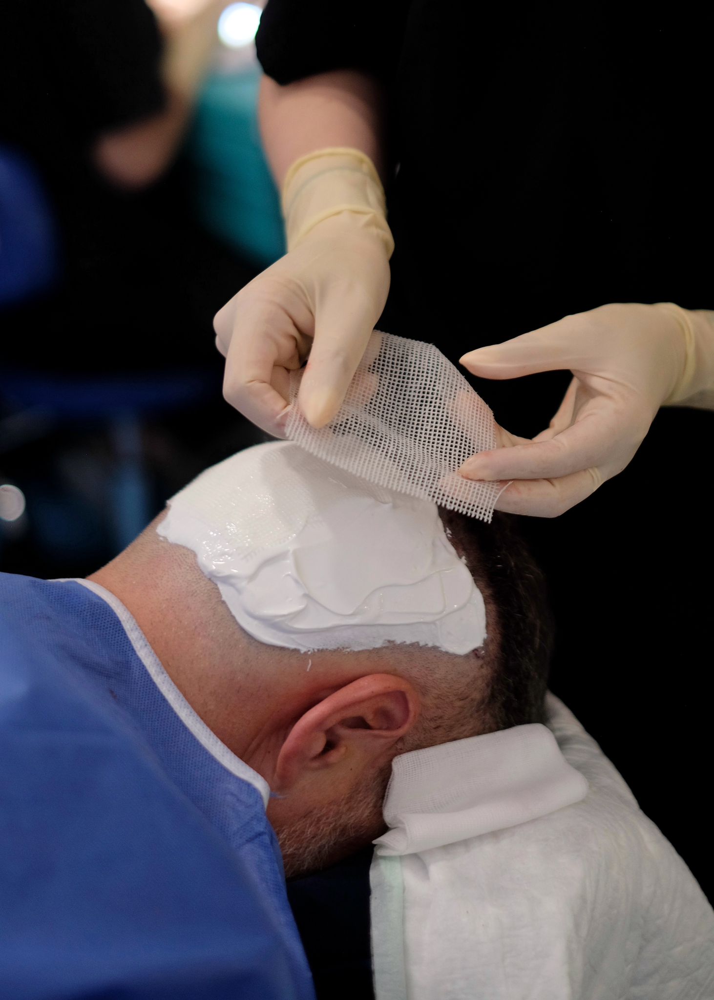 intervention capillaire au cabinet d médecine esthétique du docteur martial bodnar